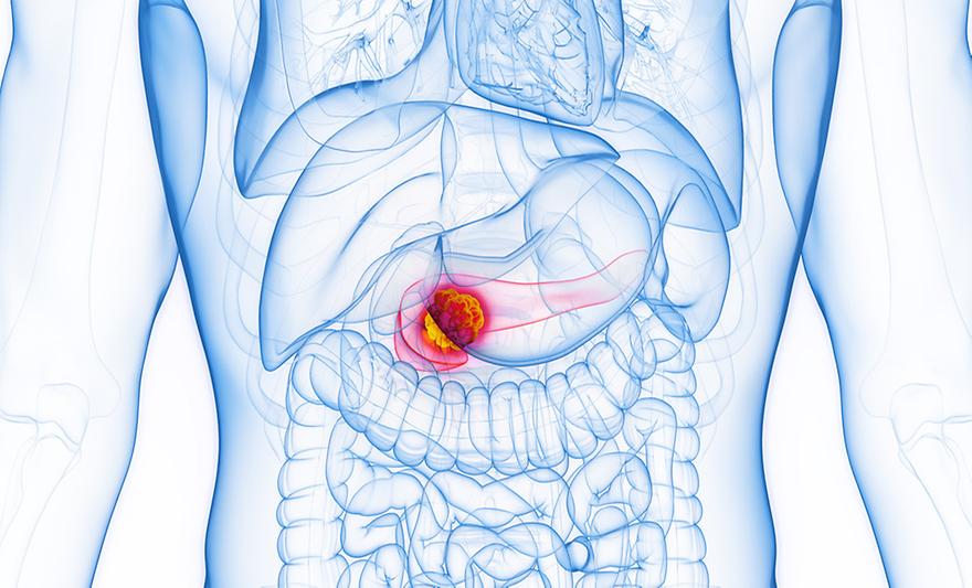 아주대-서울대 연구팀,  췌장암 환자·모델 조직의 불일치 현상 규명